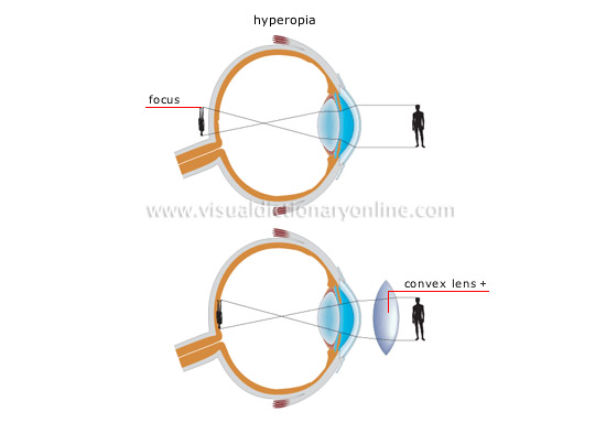 vision defects [2]